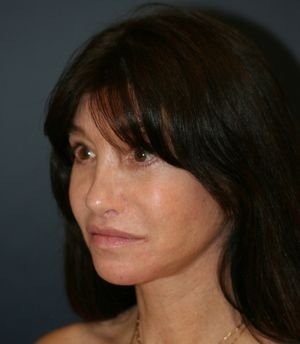 Hairline Lowering - after - right oblique