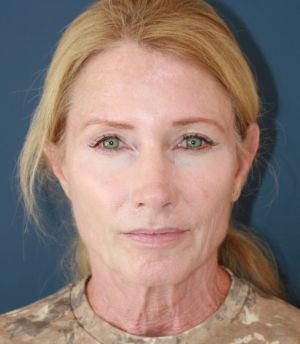 Face Neck Laser Rx - before - front