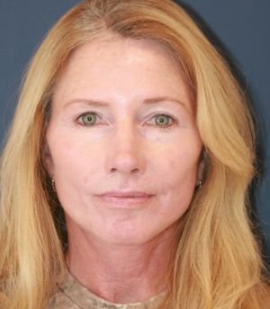 Face Neck Laser Rx - after - front