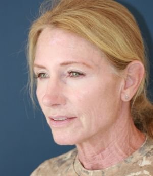 Face Neck Laser Rx - before - oblique