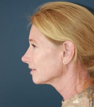 Face Neck Laser Rx - before - side