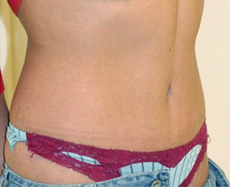 Tummy Tuck Case 2 - after - angle