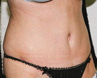 Tummy Tuck Case 11 - after - angle
