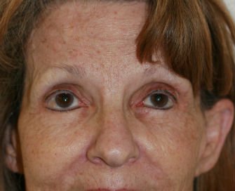 Blepharoplasty Case 32 - before - front