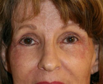 Blepharoplasty Case 32 - after - front