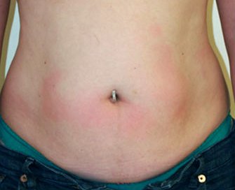 Tummy Tuck Case 12 - before - front