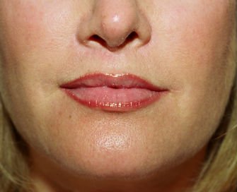 Lips Case 6 - after - front