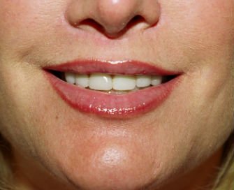 Lips Case 7 - after - front