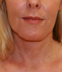 Necklift case 8 - after - side