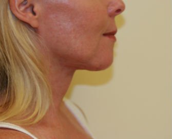 Necklift case 8 - after - front
