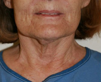 Necklift case 9 - before - side