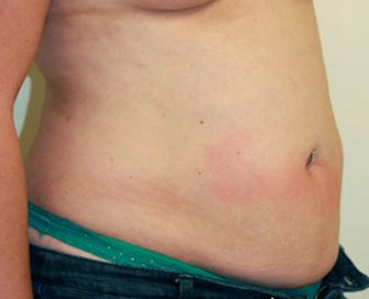 Tummy Tuck Case 12 - before - angle