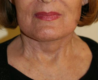 Necklift case 9 - after - side