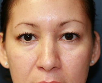 Blepharoplasty Case 33 - before - front