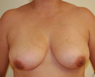 Breast Lift Case 9 - before - oblique