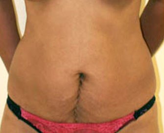 Tummy Tuck Case 14 - before - front
