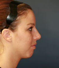Rhinoplasty case 22 - after - front
