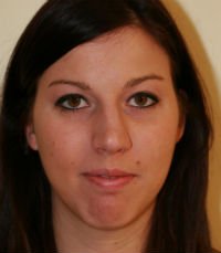 Rhinoplasty case 22 - before - side