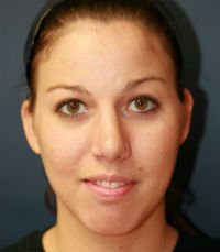 Rhinoplasty case 22 - after - side