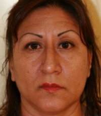 Rhinoplasty Case 11 - before - side