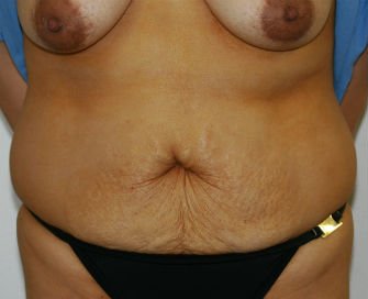 Tummy Tuck Case 29 - before - front