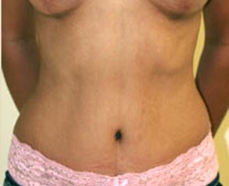 Tummy Tuck Case 14 - after - front