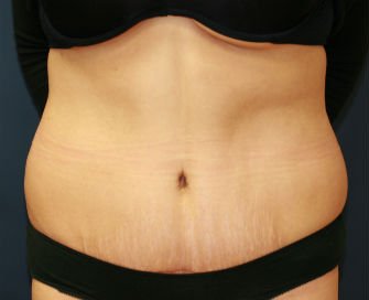 Tummy Tuck Case 29 - after - front