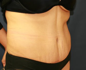 Tummy Tuck Case 29 - after - oblique