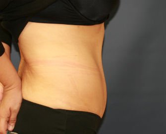 Tummy Tuck Case 29 - after - side