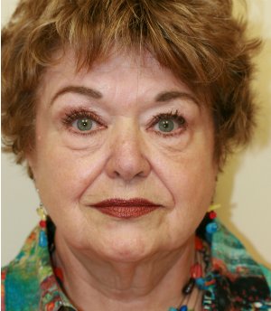 Facelift Case 13 - before - front