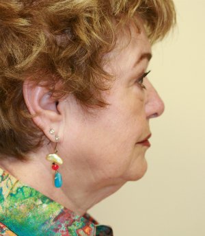 Facelift Case 13 - before - side