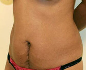 Tummy Tuck Case 14 - before - angle
