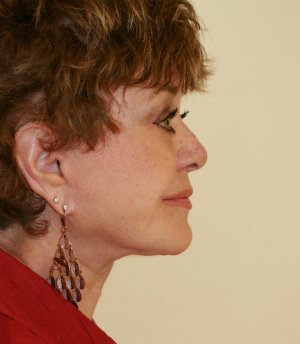 Facelift Case 13 - after - side
