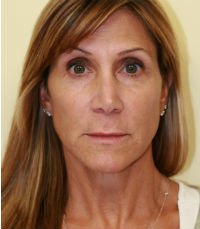 Facelift Case 14 - before - oblique