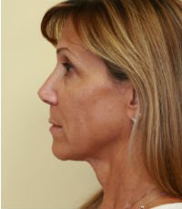 Facelift Case 14 - before - side