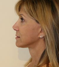 Facelift Case 14 - after - side