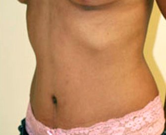 Tummy Tuck Case 14 - after - angle