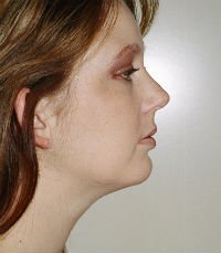 Chin Case 2 - after - side