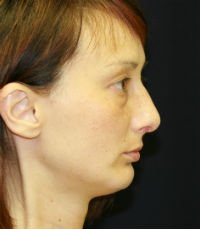 Chin Case 3 - after - side