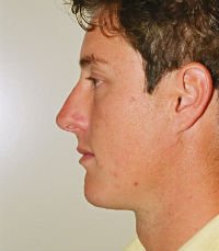 Chin Case 4 - after - front