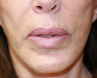 Lips Case 12 - before - front
