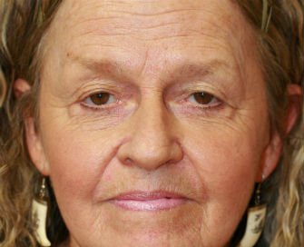 Blepharoplasty Case 35 - before - front
