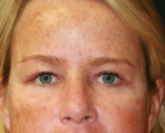 Blepharoplasty Case 36 - after - front