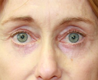 Laser resurfacing - before - front