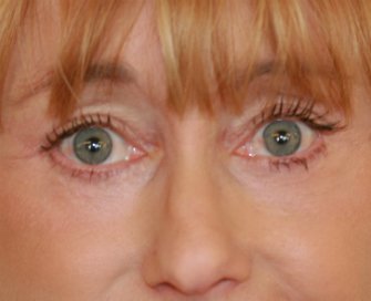 Laser resurfacing - after - front