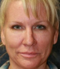 Rhinoplasty San Diego Case 23 - before - front