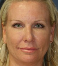Rhinoplasty San Diego Case 23 - after - front