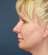 Rhinoplasty San Diego Case 23 - before - side