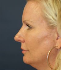 Rhinoplasty San Diego Case 23 - after - side