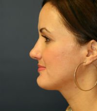Rhinoplasty San Diego Case 24 - after - front